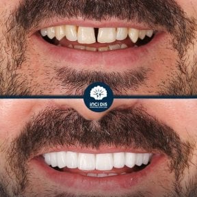 before-after photo emax-veneers