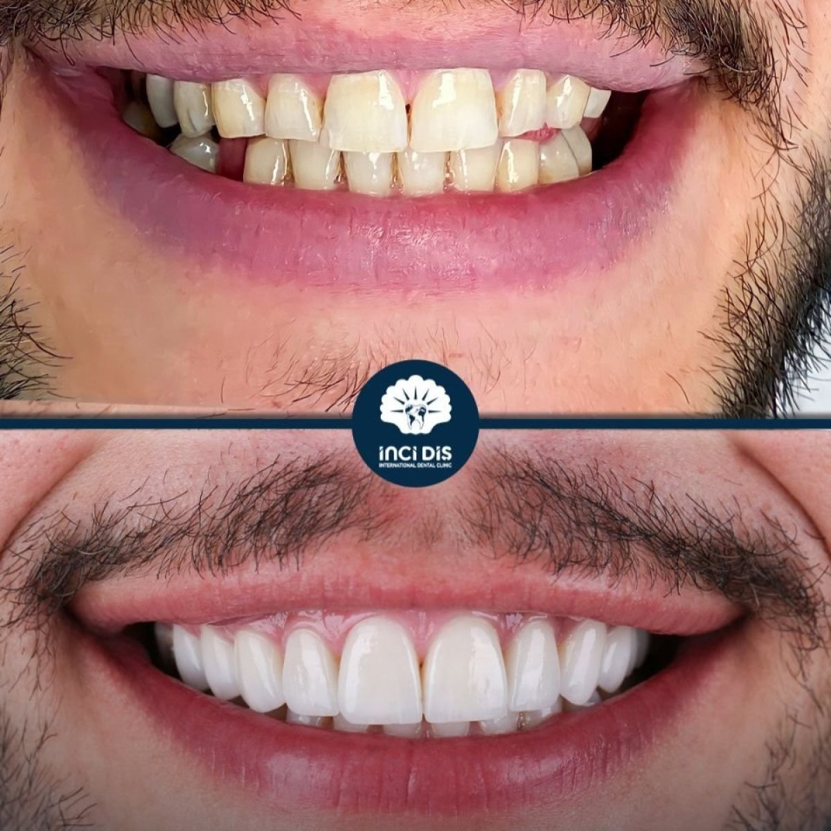 نتائج قبل وبعد عدسات إيماكس في Inci Dis International – تحول الابتسامة