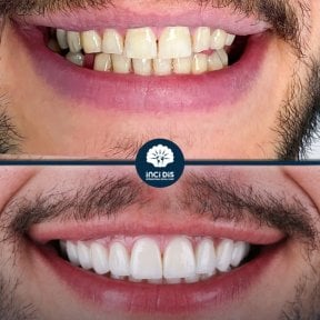 before-after photo emax-veneers
