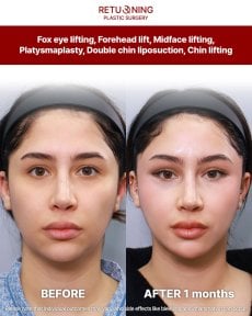 Результаты до и после фокс ай, лифтинга лба и средней зоны в Returning Plastic Surgery