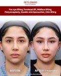 Результаты до и после фокс ай, лифтинга лба и средней зоны в Returning Plastic Surgery