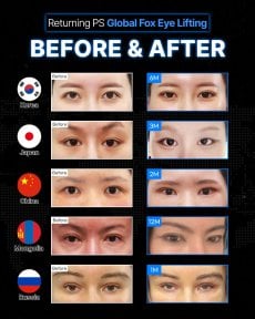 Результаты до и после фокс ай лифтинга в Returning Plastic Surgery, видимый лифтинг век