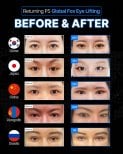 Результаты до и после фокс ай лифтинга в Returning Plastic Surgery, видимый лифтинг век