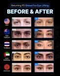 Результаты до и после Global Fox Eye Lifting в Returning Plastic Surgery, коррекция век