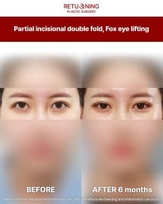 Результаты до и после частичной инцизионной двойной складки, лифтинга fox eye в Returning