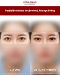 Результаты до и после частичной инцизионной двойной складки, лифтинга fox eye в Returning