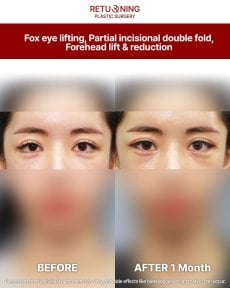 Результаты лифтинга fox eye и лифтинга лба до и после в Returning Plastic Surgery