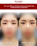 Результаты лифтинга fox eye и лифтинга лба до и после в Returning Plastic Surgery