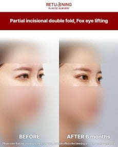 Результаты частичной инцизионной двойной складки и fox eye lifting в Returning Plastic Surgery