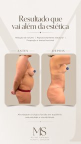 before-after photo liposakciya