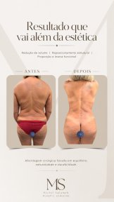 before-after photo liposakciya