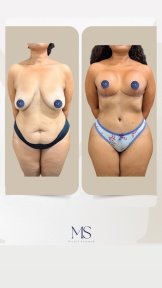 before-after photo liposakciya