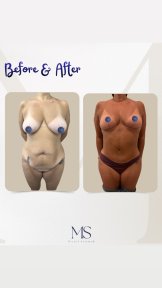 before-after photo liposakciya