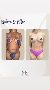 before-after photo liposakciya