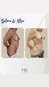 before-after photo liposakciya