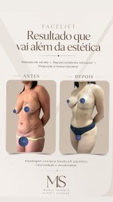 before-after photo liposakciya