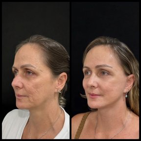 before-after photo blefaroplastika-korrekciya-vek