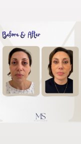 before-after photo blefaroplastika-korrekciya-vek