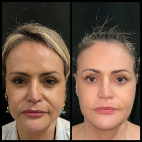 before-after photo blefaroplastika-korrekciya-vek