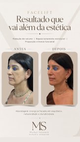 before-after photo blefaroplastika-korrekciya-vek