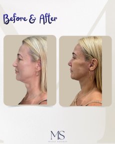 before-after photo blefaroplastika-korrekciya-vek
