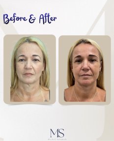 before-after photo blefaroplastika-korrekciya-vek