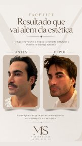 before-after photo blefaroplastika-korrekciya-vek