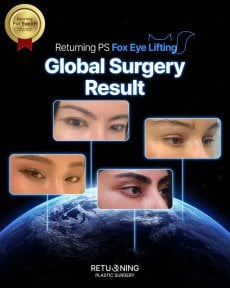 Fox Eye Lift Ergebnisse bei Returning Plastic Surgery – weltweite Augenlifting-Ergebnisse