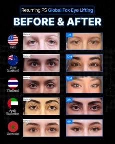 Vorher-nachher-Ergebnisse Fox Eye Lift bei Returning Plastic Surgery, sichtbare Augenstraffung