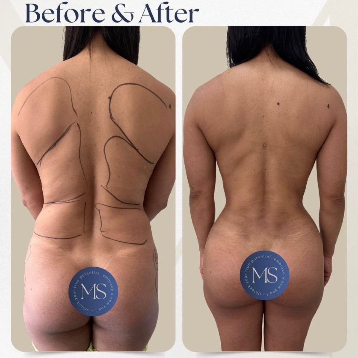Resultados de liposucción antes y después en Dr. Michel Salameh - Plastic And Aesthetic Surgery