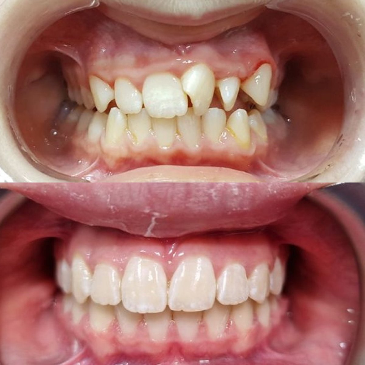 Resultados antes y después de ortodoncia en Dental Clinic Dynasty Stomatology en Praga, alineación dental