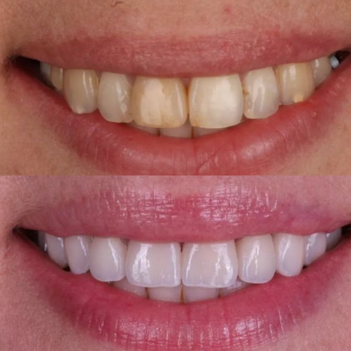 نتيجة قبل وبعد الفينير في عيادة Dental Clinic Dynasty Stomatology في براغ، تجميل الابتسامة