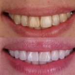 Before and after veneers result at Dental Clinic Dynasty Stomatology in Prague, smile makeover