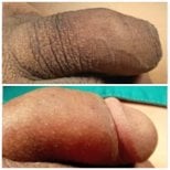 Before and after penis enlargement results at Menness Wellness Clinic, visible size increase