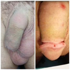 Before and after penis enlargement results at Menness Wellness Clinic, visible size increase
