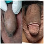 Before and after penis enlargement results at Menness Wellness Clinic, visible size improvement