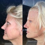 Facial fat transfer before and after results at Dr. Safa Manav Clinic, enhanced facial contours