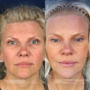 Before and after facial fat transfer results at Dr. Safa Manav Clinic, rejuvenated appearance