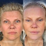 Before and after facial fat transfer results at Dr. Safa Manav Clinic, rejuvenated appearance