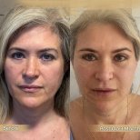 Facial fat transfer before and after results at Dr. Safa Manav Clinic, 3 months post-op