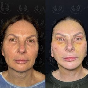 Facelift before and after results at Dr. Safa Manav Clinic – visible facial rejuvenation