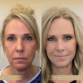 Facelift before and after results at Dr. Safa Manav Clinic, 9 months post-op facial rejuvenation