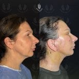 Before and after facelift results at Dr. Safa Manav Clinic, visible facial rejuvenation