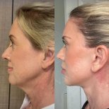Facelift before and after results at Dr. Safa Manav Clinic, visible jawline and neck lift