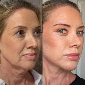 Facelift before and after results at Dr. Safa Manav Clinic – visible facial rejuvenation