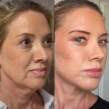 Facelift before and after results at Dr. Safa Manav Clinic – visible facial rejuvenation
