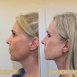 Facelift before and after results at Dr. Safa Manav Clinic, visible facial contour improvement
