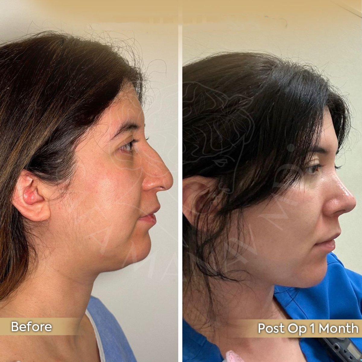 Resultados de extracción de grasa bucal antes y después en Dr. Safa Manav Clinic, rostro más delgado