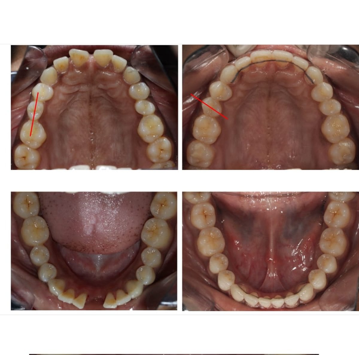 نتائج قبل وبعد تقويم الأسنان Invisalign – تحسين استقامة الأسنان وابتسامة أكثر انتظامًا