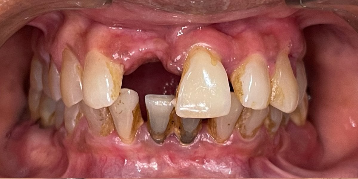 Antes de implantes dentales All-on-6, dientes faltantes y dañados en la mandíbula superior